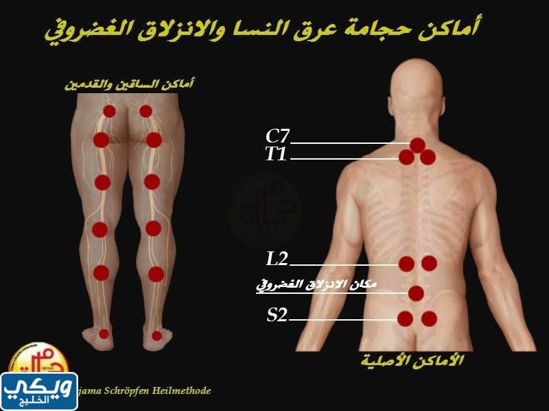 أماكن الحجامة للنساء بالصور